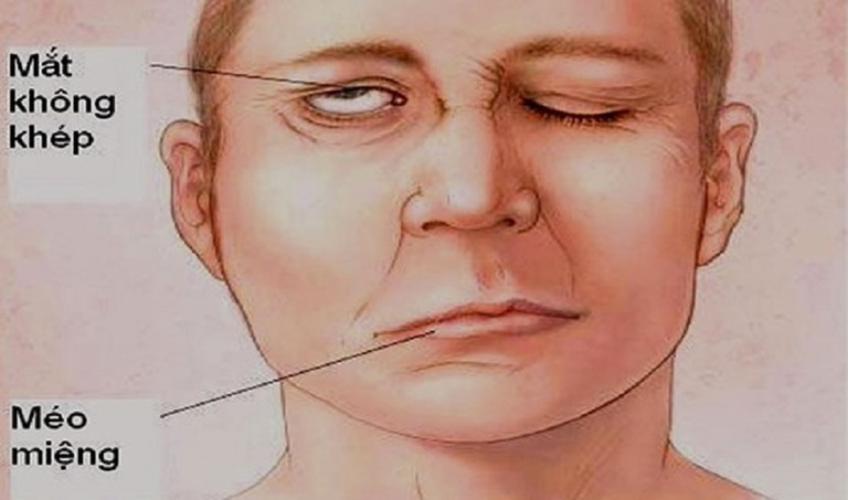 Một số ít trường hợp bị liệt cơ mặt hoặc méo miệng do bị ảnh hưởng dây thần kinh số 7 khi thực hiện cấy chỉ ở những cơ sở chui giá rẻ