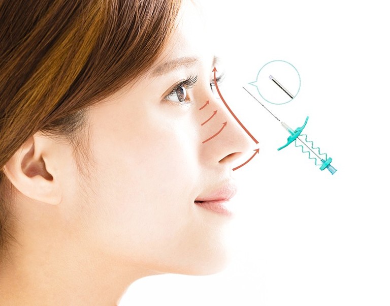 Cấy chỉ collagen nâng mũi không phẫu thuật, không xâm lấn sâu mang lại hiệu quả được nhiều bạn trẻ lựa chọn.